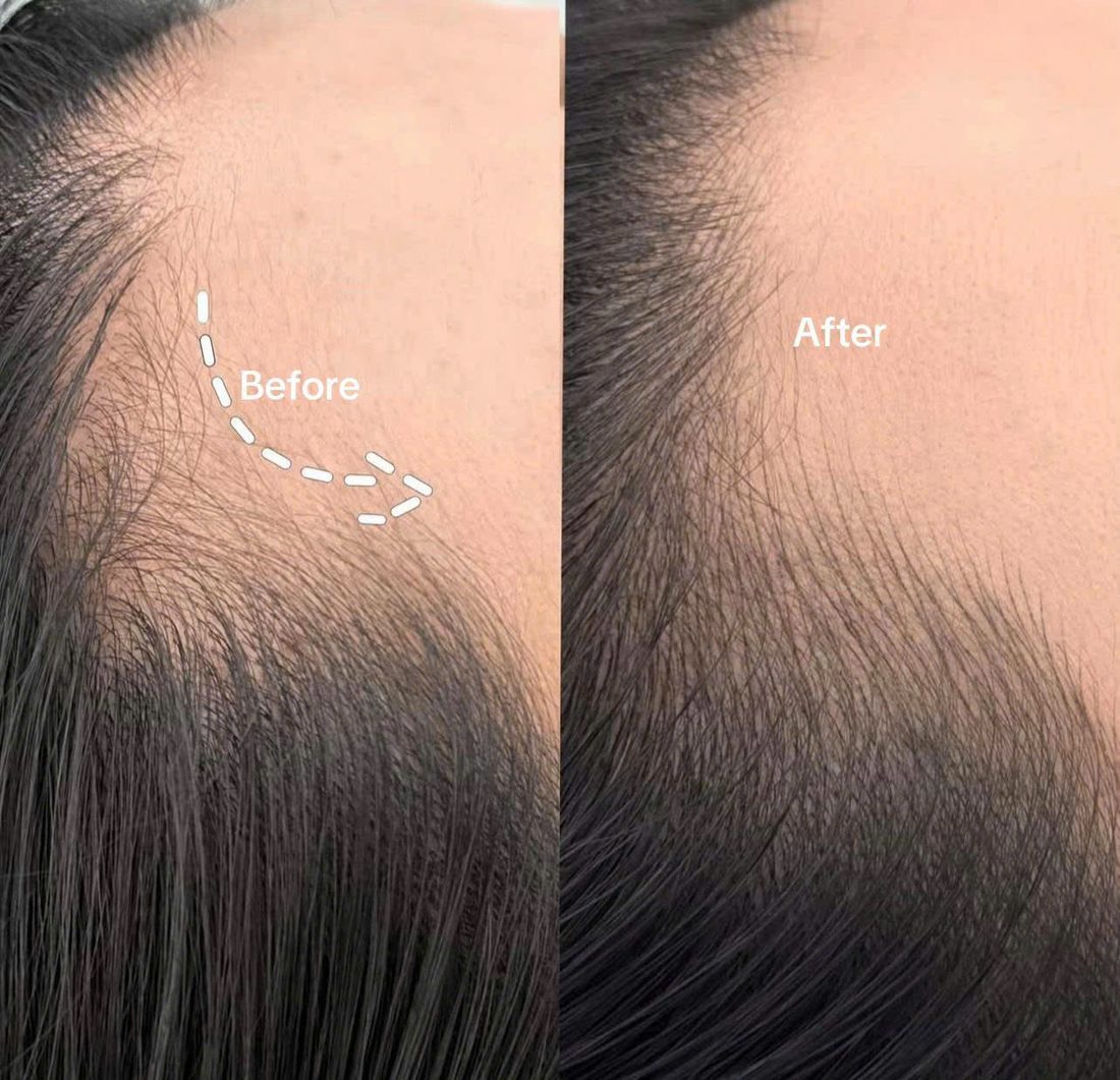 Eyebrow embroidery result by COCO BROW Singapore — photo 26