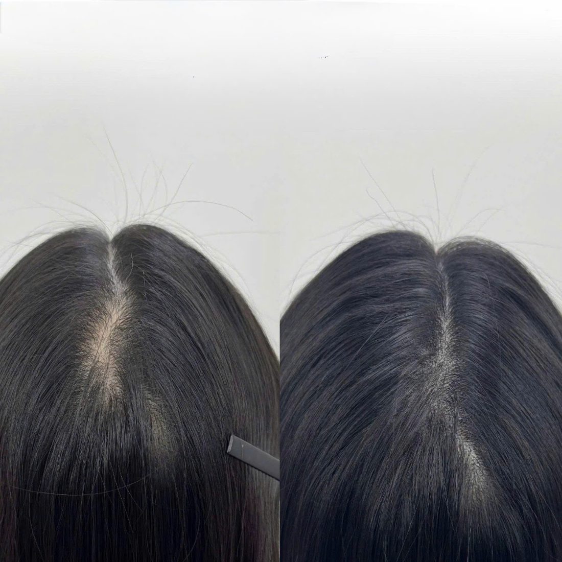 Scalp Micropigmentation (SMP) — COCO BROW Singapore