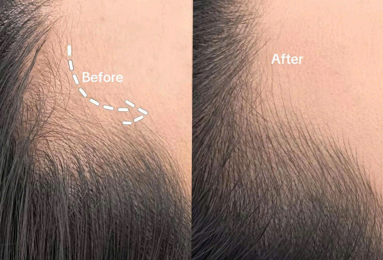 HAIR-LINE-&-HAIR-STROKE-SMP-HOME2