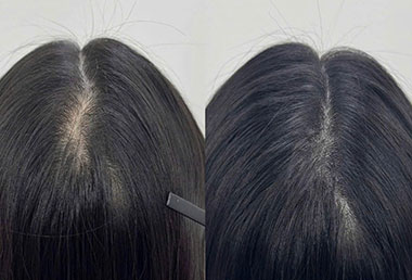 SCALP-MICROPIGMENTATION-SMP-HOME